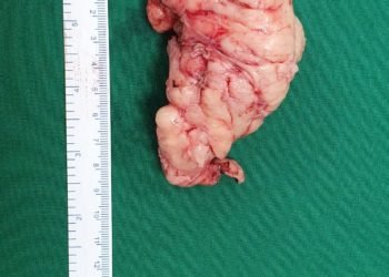 Rare surgery performed to remove tumour from esophagus