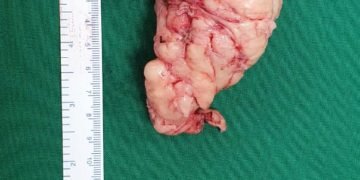 Rare surgery performed to remove tumour from esophagus