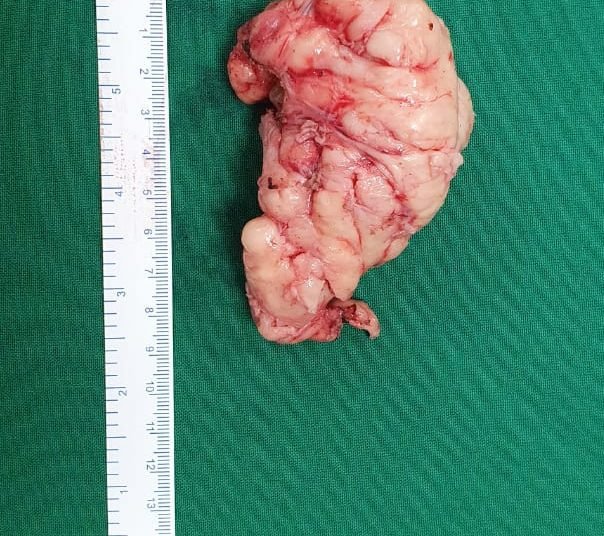 Rare surgery performed to remove tumour from esophagus