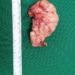 Rare surgery performed to remove tumour from esophagus