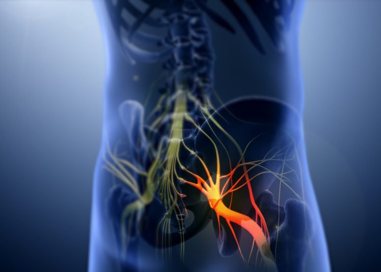 Successful stitchless Button Hole surgery performed to treat sciatica