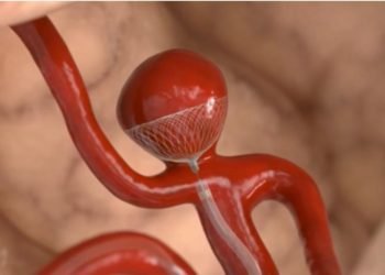 Brain aneurysm successfully treated using a contour device