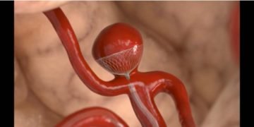 Brain aneurysm successfully treated using a contour device