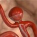 Brain aneurysm successfully treated using a contour device
