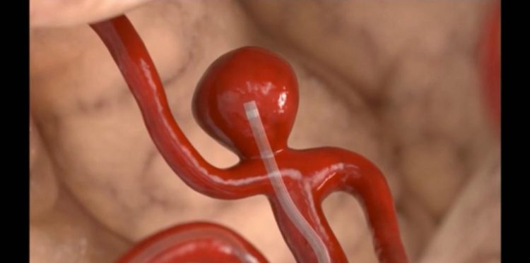 Brain aneurysm successfully treated using a contour device