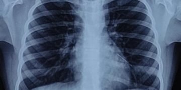 A metallic pin successfully removed from a child’s lung after 2 years