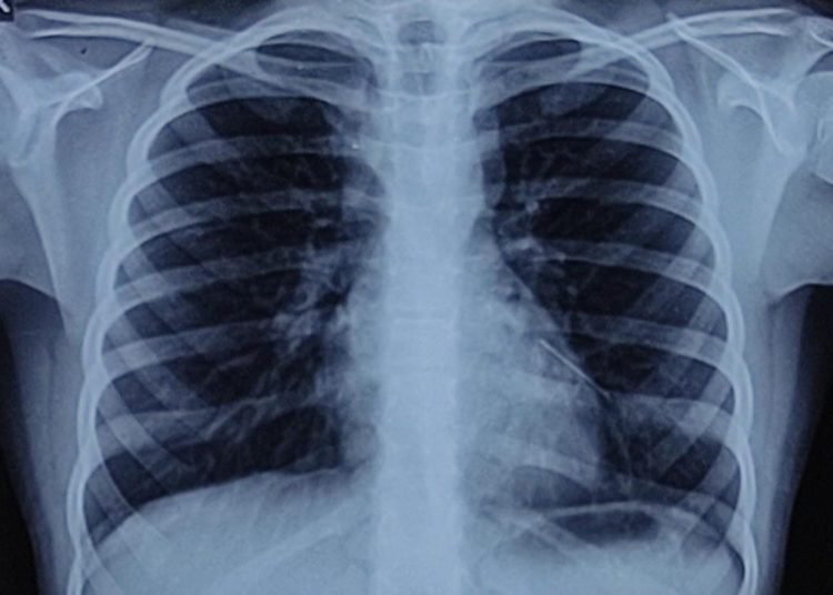 A metallic pin successfully removed from a child’s lung after 2 years