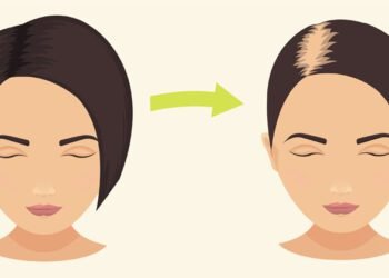 There is a steep rise in the number of post Covid patients with hair loss issues says Doctors
