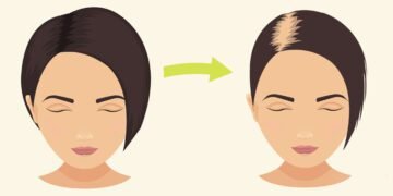 There is a steep rise in the number of post Covid patients with hair loss issues says Doctors