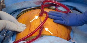 A 63yr-old woman with Advanced Abdominal Cancer successfully treated through HIPEC