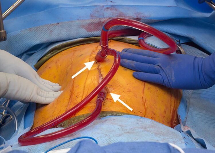 A 63yr-old woman with Advanced Abdominal Cancer successfully treated through HIPEC