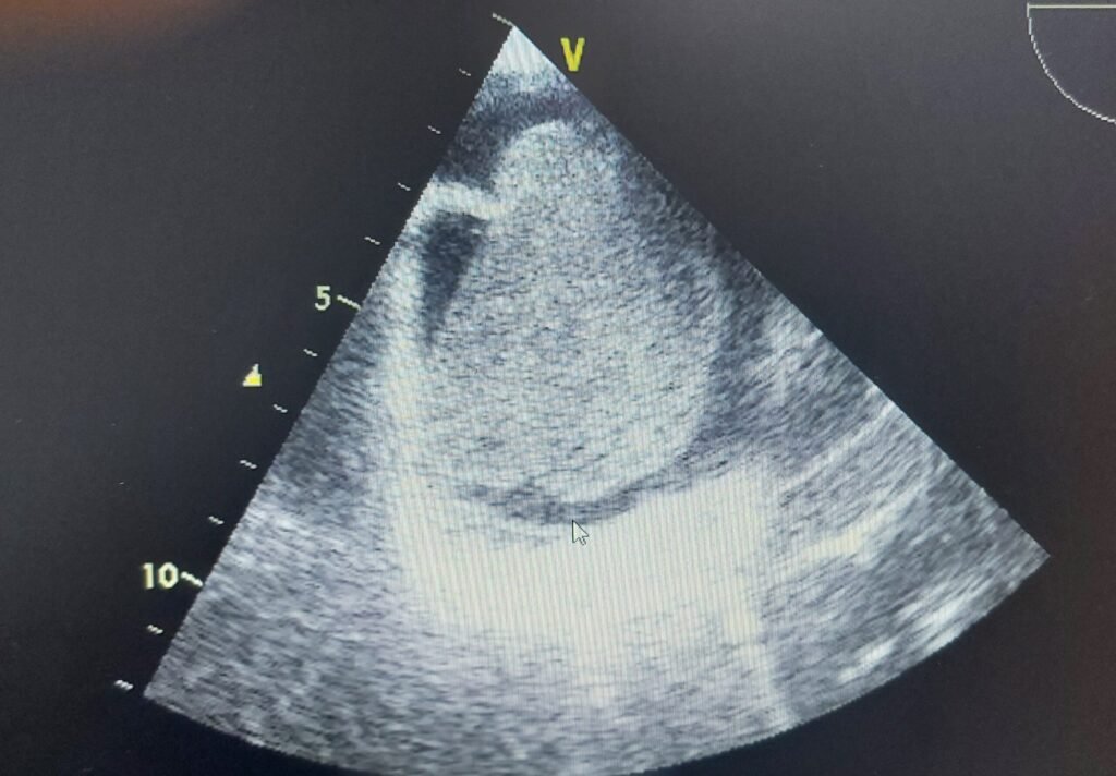 Massive heart tumor removed to save a 28 year old woman’s life