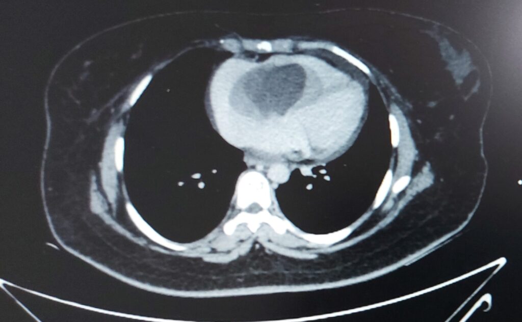 Massive heart tumor removed to save a 28 year old woman’s life