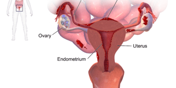 Early diagnosis and prompt treatment is key to manage Endometriosis