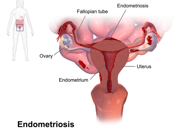Early diagnosis and prompt treatment is key to manage Endometriosis