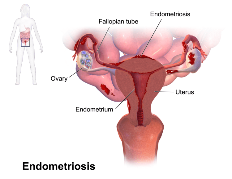 Early diagnosis and prompt treatment is key to manage Endometriosis