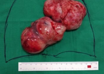 Massive heart tumor removed to save a 28 year old woman’s life