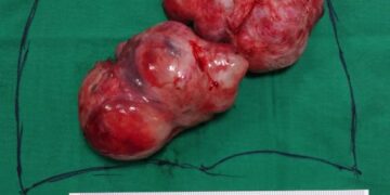 Massive heart tumor removed to save a 28 year old woman’s life