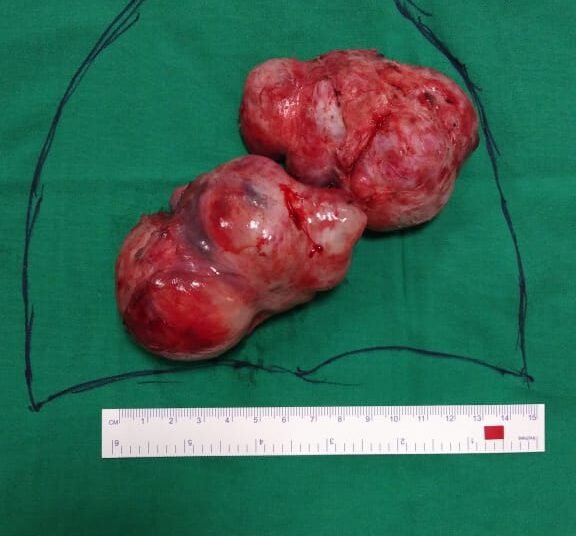 Massive heart tumor removed to save a 28 year old woman’s life
