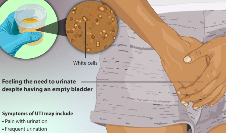 Urinary tract infections on the rise among Covid patients