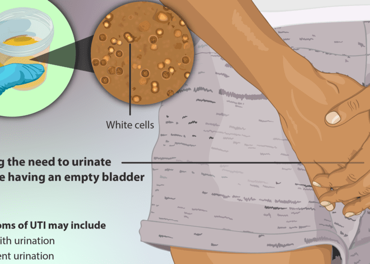 Urinary tract infections on the rise among Covid patients