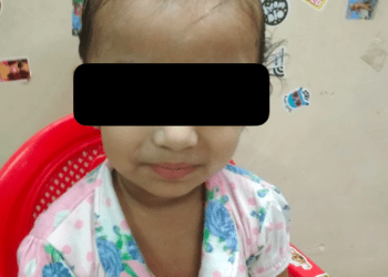 Baby with neuroblastoma successfully treated with Dinutuximab Immunotherapy at Wadia hospital