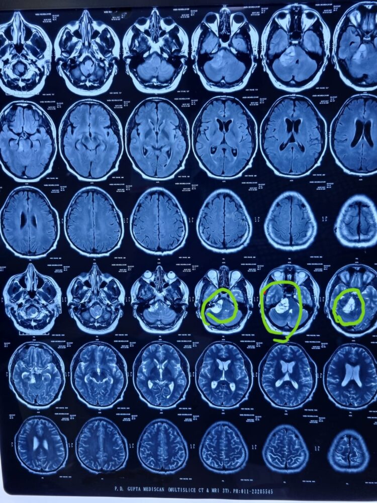 50g tumour successfully removed from an engineer’s right ear 