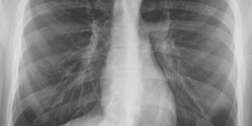 A 34yr old patient with collapsed lung successfully treated