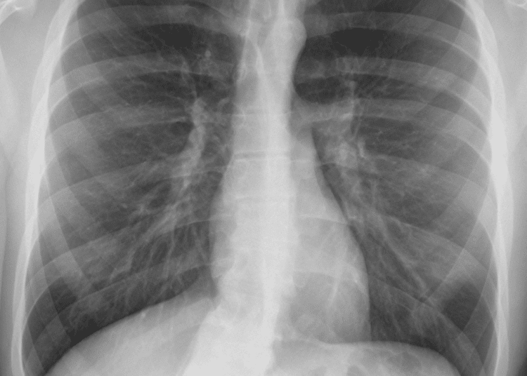 A 34yr old patient with collapsed lung successfully treated