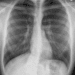 A 34yr old patient with collapsed lung successfully treated