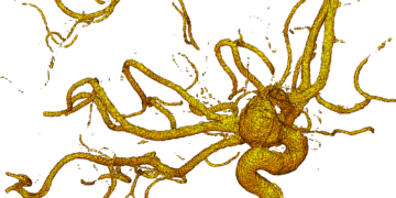 Some blood pressure medicine may decrease the aneurysm rupture risk for people with high blood pressure