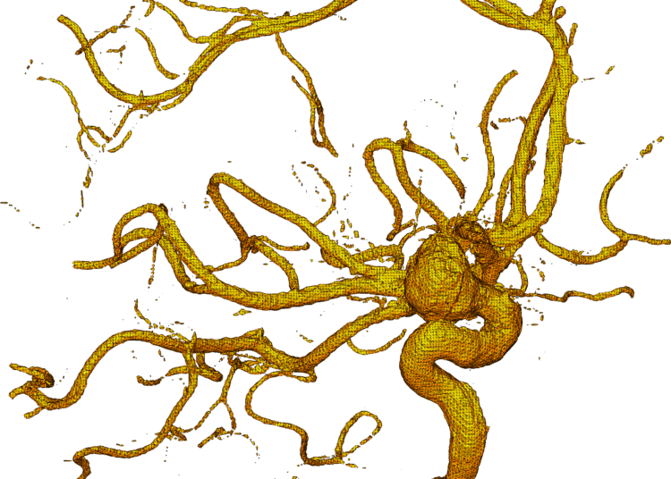 Some blood pressure medicine may decrease the aneurysm rupture risk for people with high blood pressure