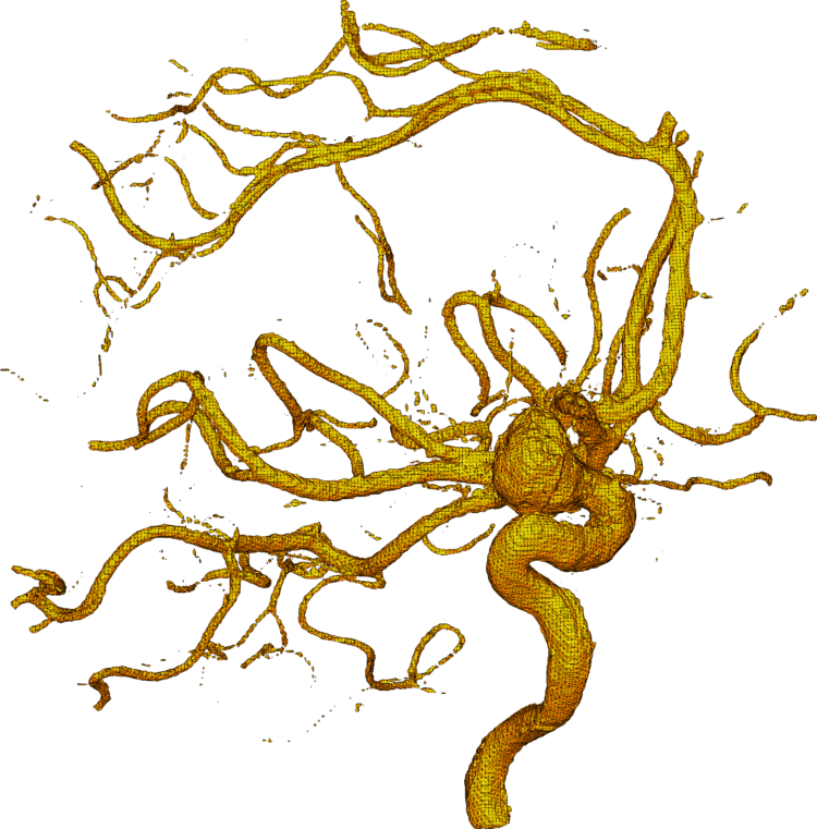 Some blood pressure medicine may decrease the aneurysm rupture risk for people with high blood pressure