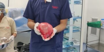 Massive uterine fibroid compression leads to extensive DVT in a  50yr-old woman