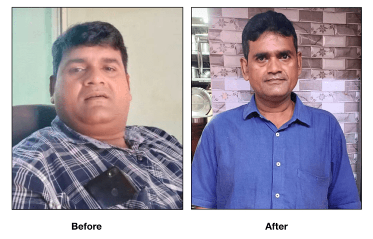 Bariatric surgery helps a 40-yr old Mumbai man to lose 43 kgs