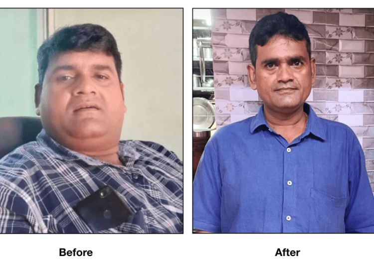 Bariatric surgery helps a 40-yr old Mumbai man to lose 43 kgs