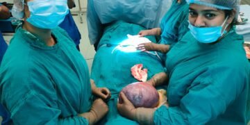 A 2.5 kg cyst with multiple fibroids successfully removed from a 48yr-old woman’s uterus