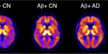 Novel PET imaging agent detects earliest signs of Alzheimer’s disease
