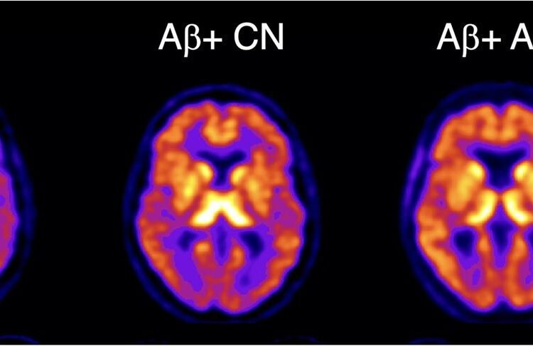 Novel PET imaging agent detects earliest signs of Alzheimer’s disease