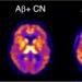 Novel PET imaging agent detects earliest signs of Alzheimer’s disease