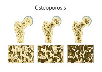 Increase in osteoporosis cases post Covid due to psychological effects