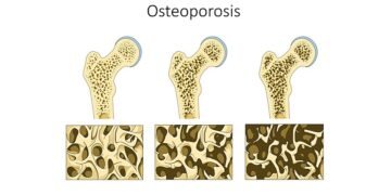 Increase in osteoporosis cases post Covid due to psychological effects