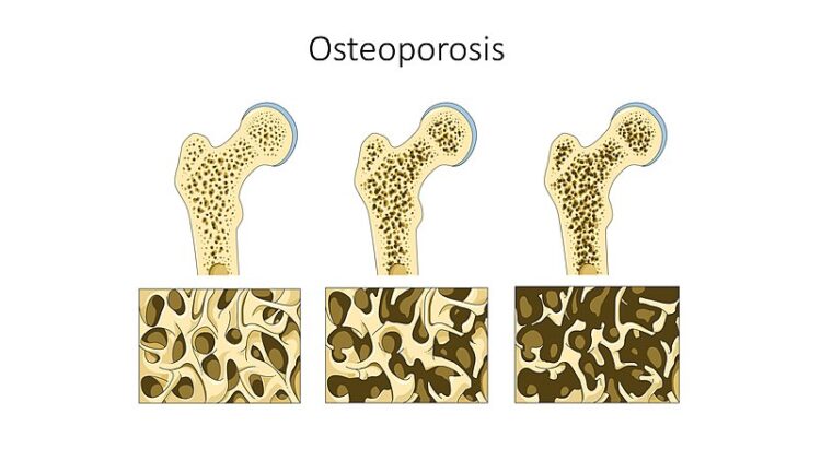 Increase in osteoporosis cases post Covid due to psychological effects