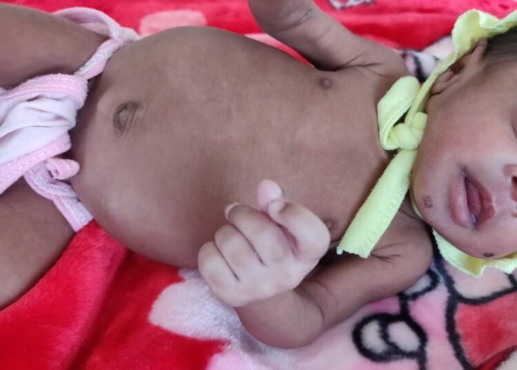 Rare Intestinal Malrotation in premature baby successfully treated