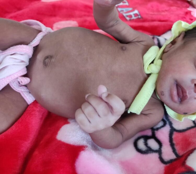 Rare Intestinal Malrotation in premature baby successfully treated