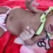 Rare Intestinal Malrotation in premature baby successfully treated