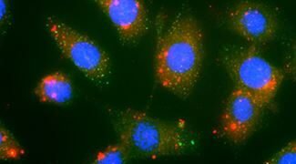 Novel nanoparticles deliver innovative cancer chemoimmun