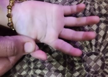 Doctors at Wockhardt Hospital re-join severed index finger of a 20-month-old child