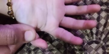 Doctors at Wockhardt Hospital re-join severed index finger of a 20-month-old child