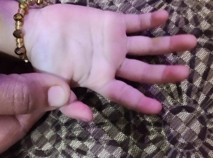 Doctors at Wockhardt Hospital re-join severed index finger of a 20-month-old child